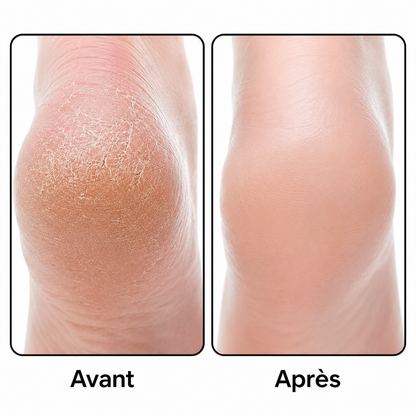 Râpe Électrique pour Pieds